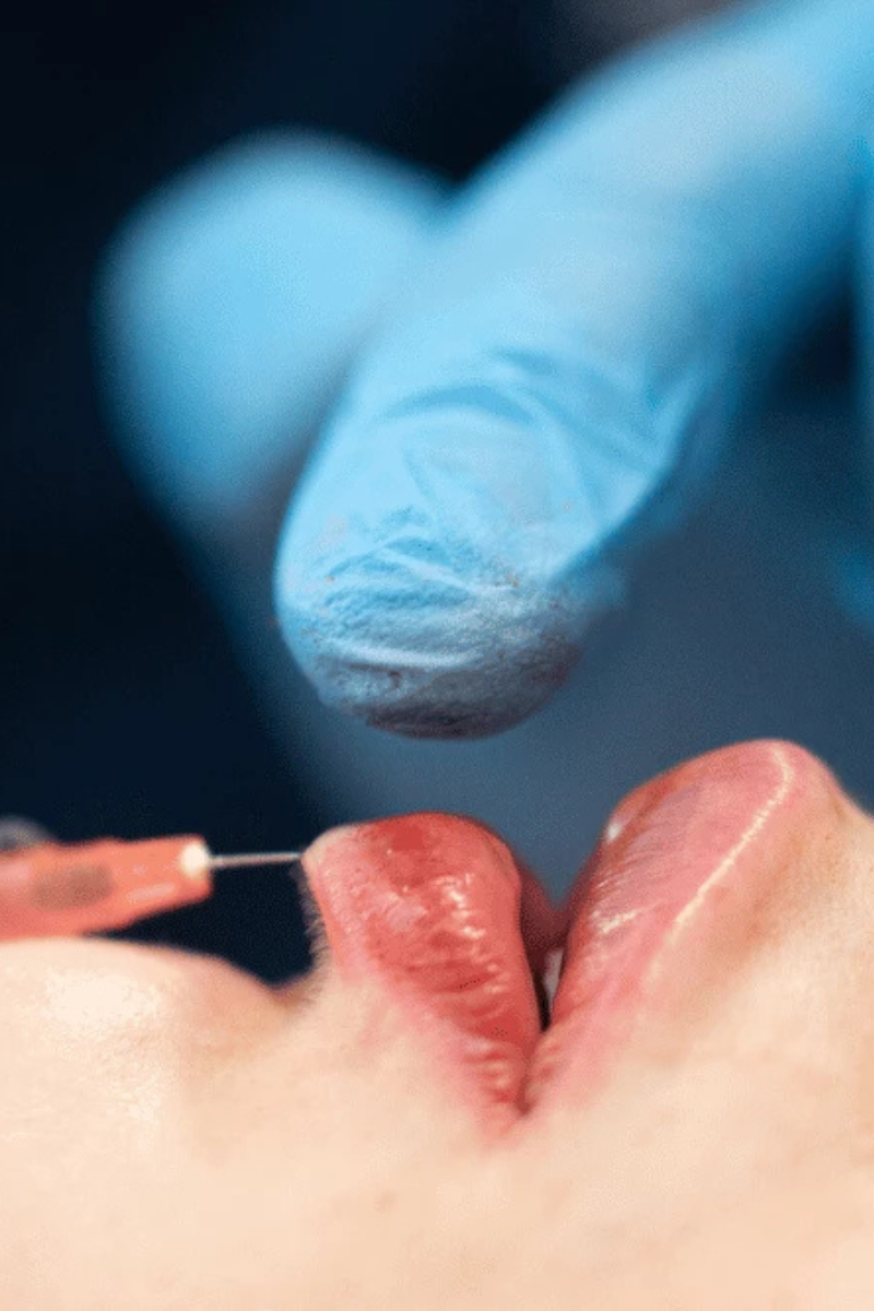 acide hyaluronique lyon