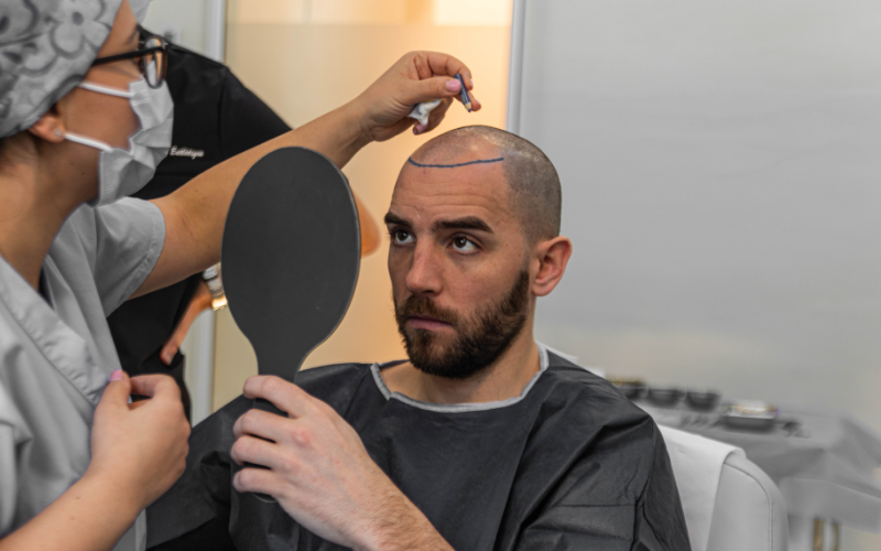 greffe cheveux FUE Lyon