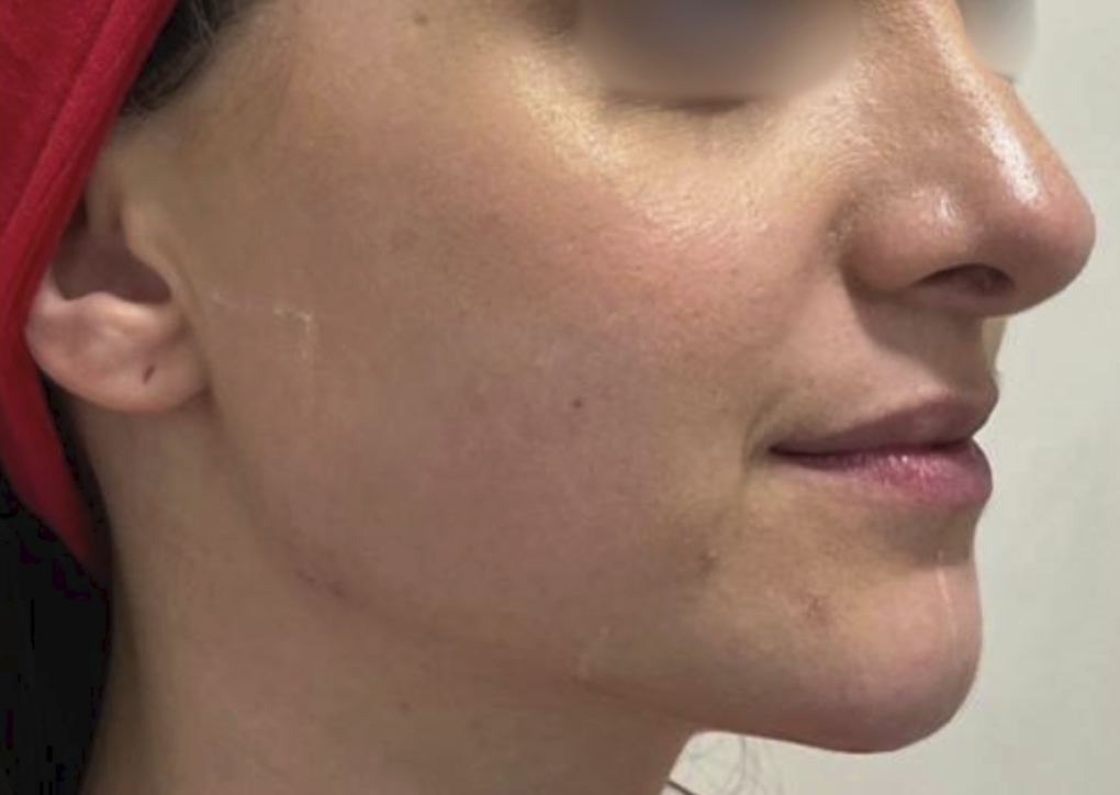 jawline acide hyaluronique lyon