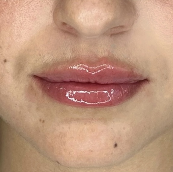 injection acide hyaluronique levre lyon